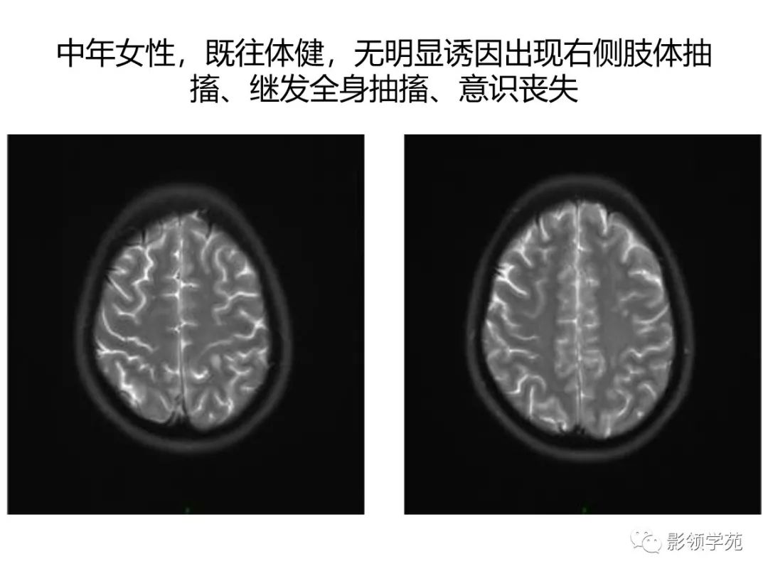 影像PPT - 【PPT】头颅T2-Flair增强扫描的意义及临床应用-19 影像PPT - 【PPT】头颅T2-Flair增强扫描的意义及临床应用-19