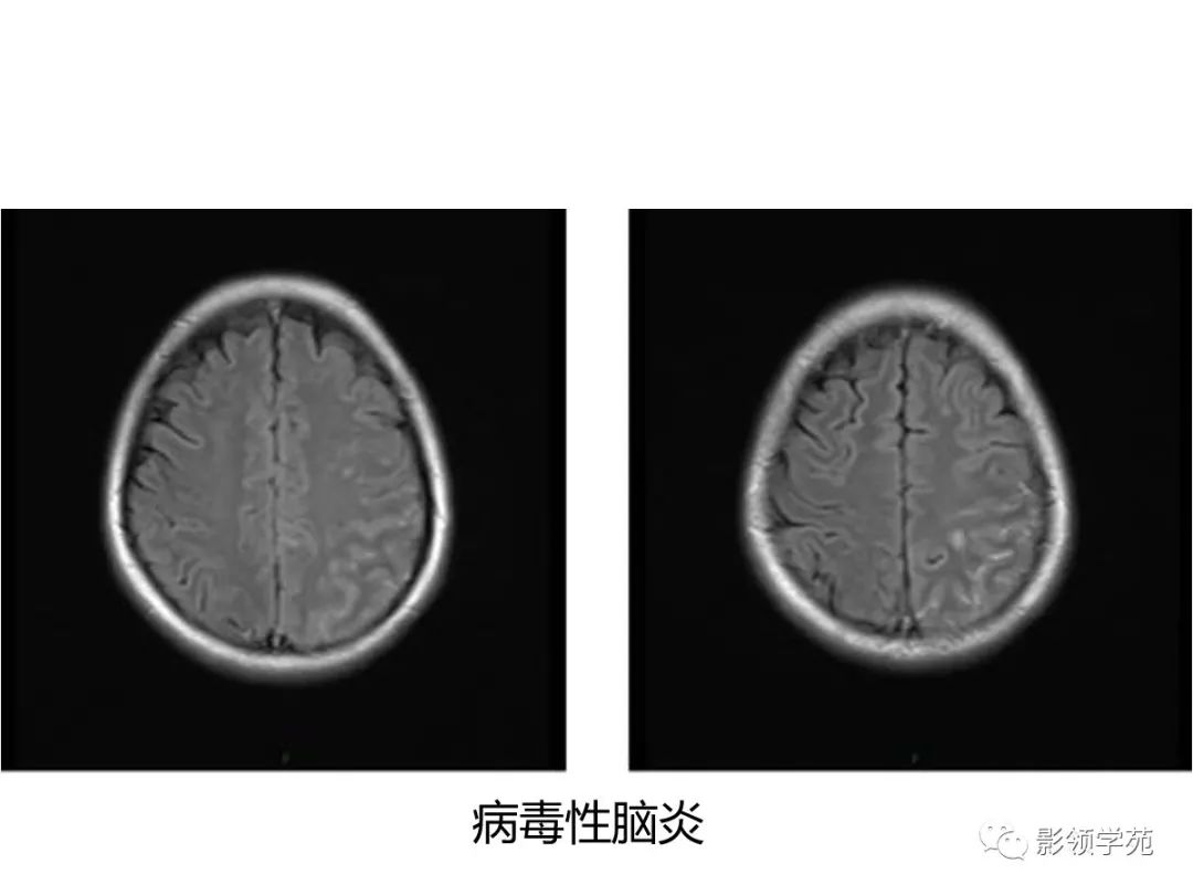 影像PPT - 【PPT】头颅T2-Flair增强扫描的意义及临床应用-24 影像PPT - 【PPT】头颅T2-Flair增强扫描的意义及临床应用-24