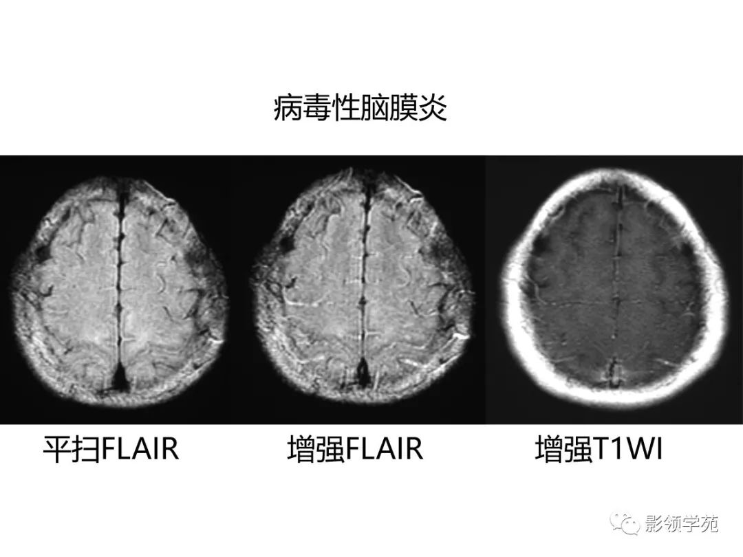 影像PPT - 【PPT】头颅T2-Flair增强扫描的意义及临床应用-25 影像PPT - 【PPT】头颅T2-Flair增强扫描的意义及临床应用-25