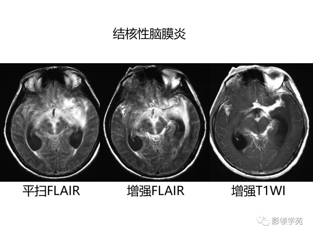 影像PPT - 【PPT】头颅T2-Flair增强扫描的意义及临床应用-27 影像PPT - 【PPT】头颅T2-Flair增强扫描的意义及临床应用-27