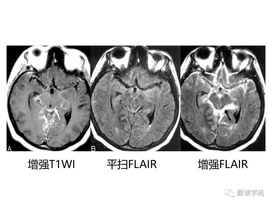 影像PPT - 【PPT】头颅T2-Flair增强扫描的意义及临床应用-28 影像PPT - 【PPT】头颅T2-Flair增强扫描的意义及临床应用-28