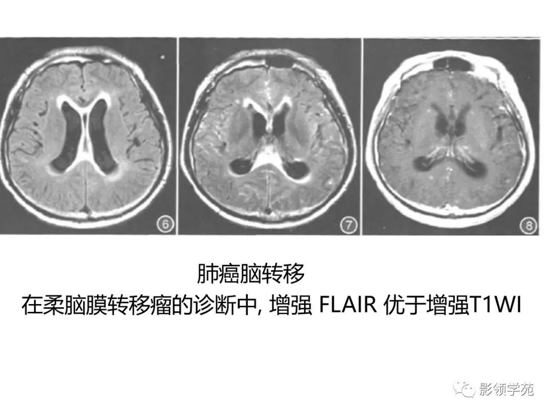 影像PPT - 【PPT】头颅T2-Flair增强扫描的意义及临床应用-30 影像PPT - 【PPT】头颅T2-Flair增强扫描的意义及临床应用-30