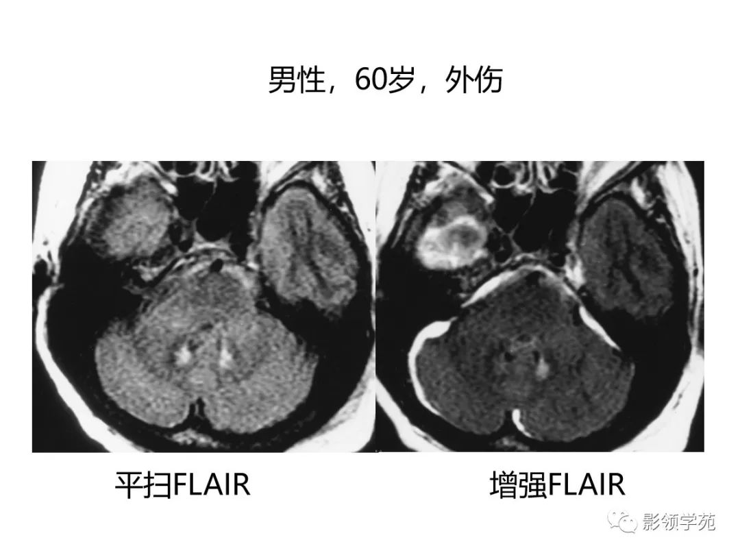 影像PPT - 【PPT】头颅T2-Flair增强扫描的意义及临床应用-32 影像PPT - 【PPT】头颅T2-Flair增强扫描的意义及临床应用-32
