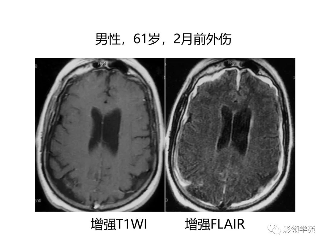 影像PPT - 【PPT】头颅T2-Flair增强扫描的意义及临床应用-33 影像PPT - 【PPT】头颅T2-Flair增强扫描的意义及临床应用-33