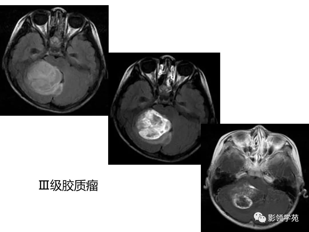 影像PPT - 【PPT】头颅T2-Flair增强扫描的意义及临床应用-36 影像PPT - 【PPT】头颅T2-Flair增强扫描的意义及临床应用-36