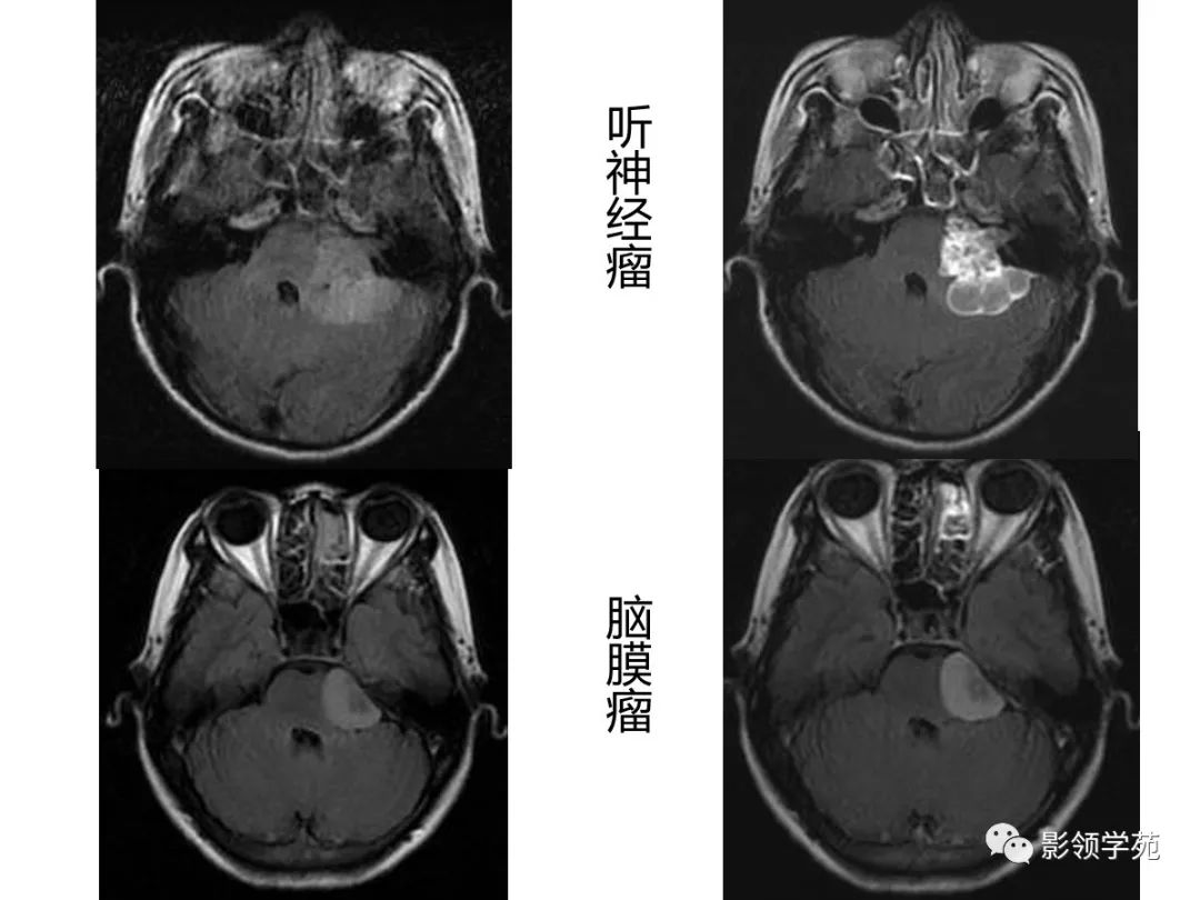 影像PPT - 【PPT】头颅T2-Flair增强扫描的意义及临床应用-45 影像PPT - 【PPT】头颅T2-Flair增强扫描的意义及临床应用-45