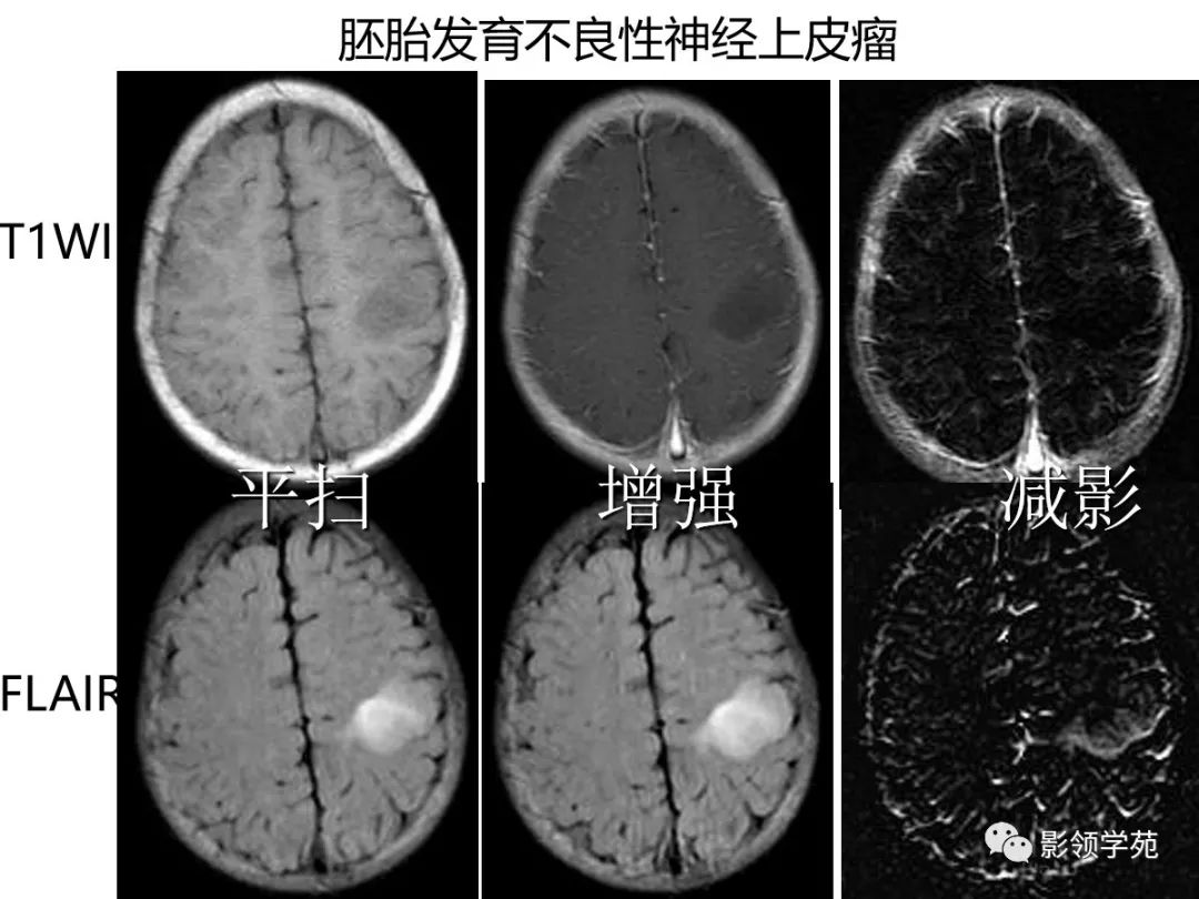 影像PPT - 【PPT】头颅T2-Flair增强扫描的意义及临床应用-47 影像PPT - 【PPT】头颅T2-Flair增强扫描的意义及临床应用-47