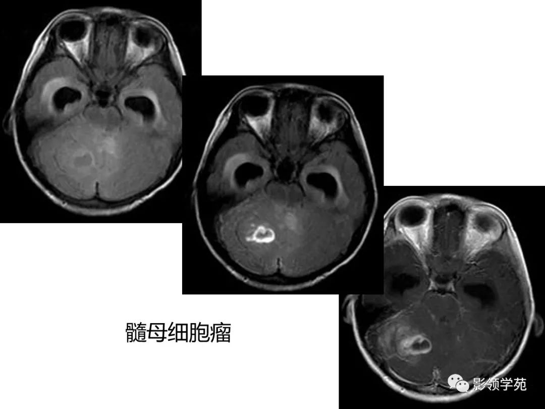 影像PPT - 【PPT】头颅T2-Flair增强扫描的意义及临床应用-48 影像PPT - 【PPT】头颅T2-Flair增强扫描的意义及临床应用-48
