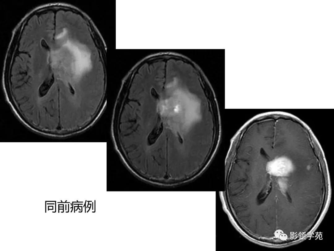 影像PPT - 【PPT】头颅T2-Flair增强扫描的意义及临床应用-52 影像PPT - 【PPT】头颅T2-Flair增强扫描的意义及临床应用-52