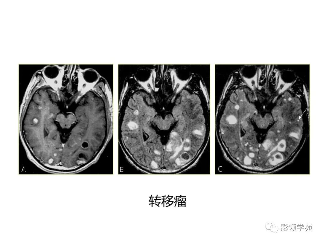 影像PPT - 【PPT】头颅T2-Flair增强扫描的意义及临床应用-54 影像PPT - 【PPT】头颅T2-Flair增强扫描的意义及临床应用-54
