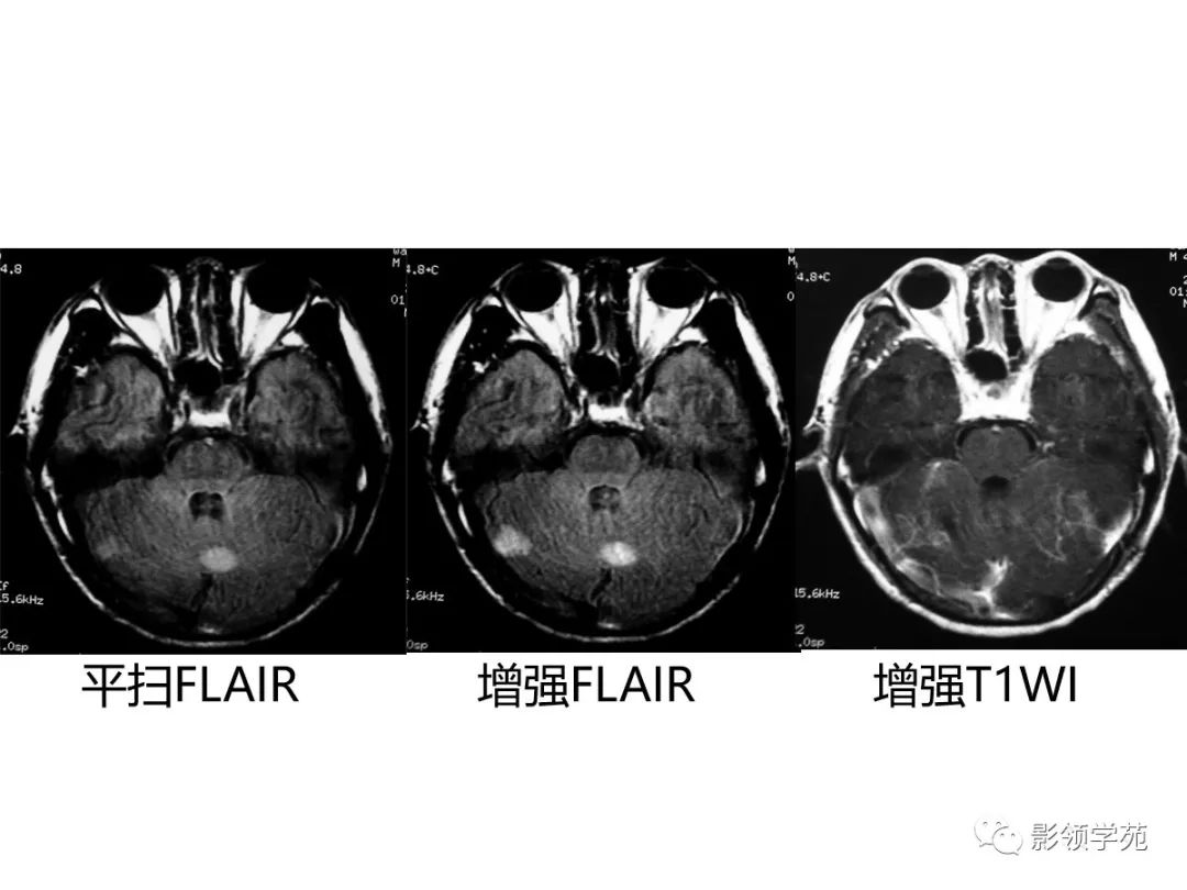 影像PPT - 【PPT】头颅T2-Flair增强扫描的意义及临床应用-56 影像PPT - 【PPT】头颅T2-Flair增强扫描的意义及临床应用-56
