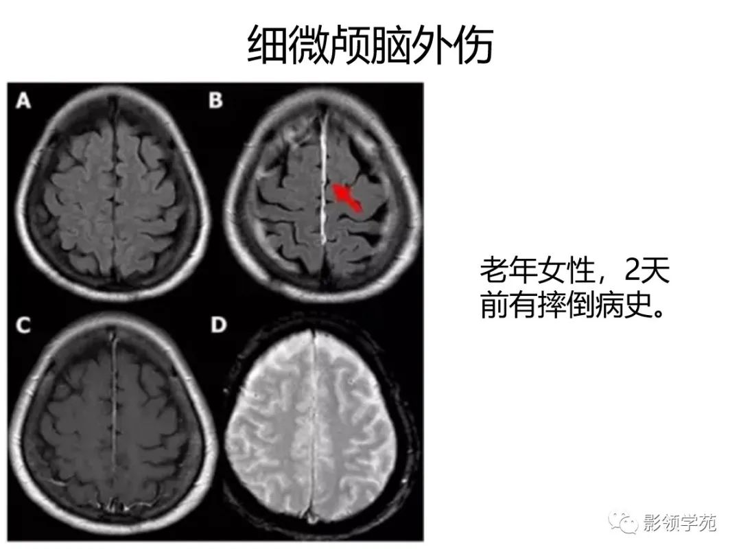影像PPT - 【PPT】头颅T2-Flair增强扫描的意义及临床应用-60 影像PPT - 【PPT】头颅T2-Flair增强扫描的意义及临床应用-60