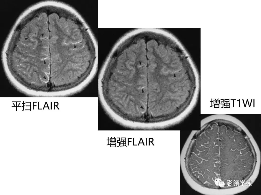影像PPT - 【PPT】头颅T2-Flair增强扫描的意义及临床应用-63 影像PPT - 【PPT】头颅T2-Flair增强扫描的意义及临床应用-63