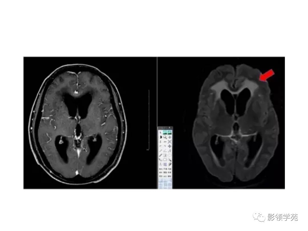 影像PPT - 【PPT】头颅T2-Flair增强扫描的意义及临床应用-65 影像PPT - 【PPT】头颅T2-Flair增强扫描的意义及临床应用-65