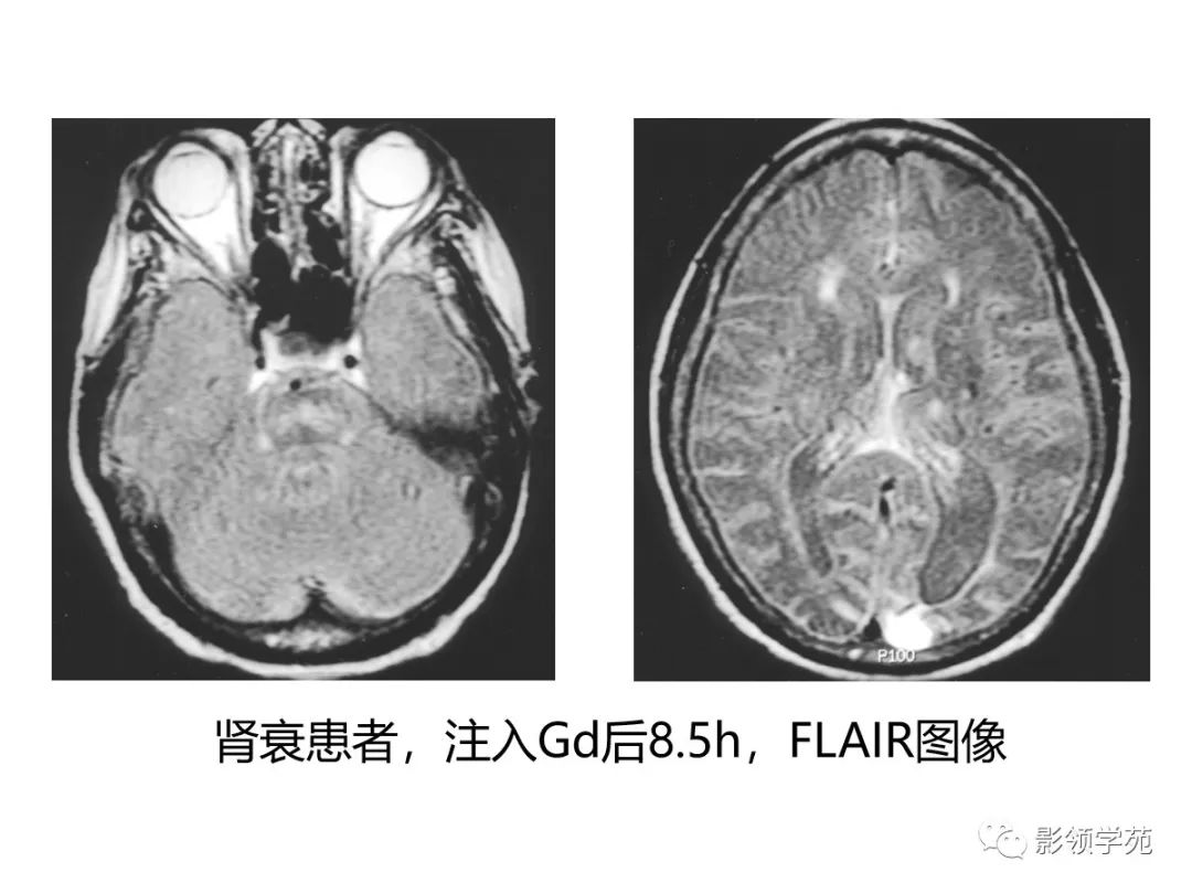 影像PPT - 【PPT】头颅T2-Flair增强扫描的意义及临床应用-66 影像PPT - 【PPT】头颅T2-Flair增强扫描的意义及临床应用-66