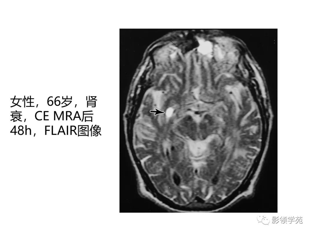 影像PPT - 【PPT】头颅T2-Flair增强扫描的意义及临床应用-67 影像PPT - 【PPT】头颅T2-Flair增强扫描的意义及临床应用-67