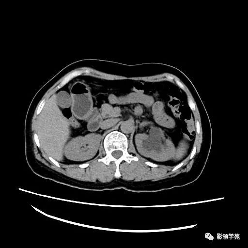 影像PPT - 【病例】腹膜后平滑肌肉瘤1例CT表现-1 影像PPT - 【病例】腹膜后平滑肌肉瘤1例CT表现-1