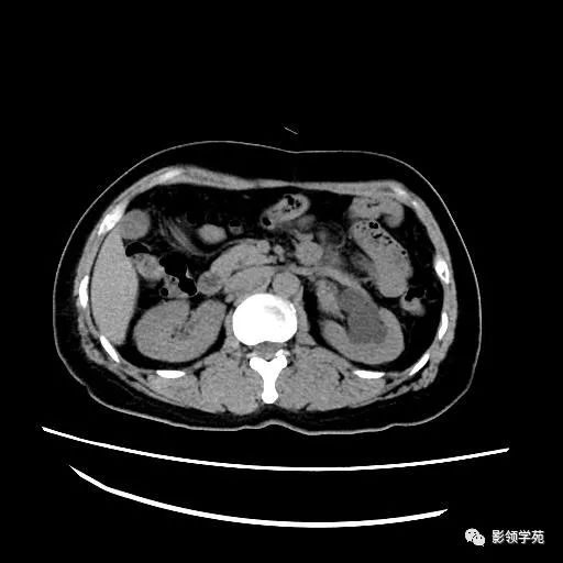 影像PPT - 【病例】腹膜后平滑肌肉瘤1例CT表现-2 影像PPT - 【病例】腹膜后平滑肌肉瘤1例CT表现-2