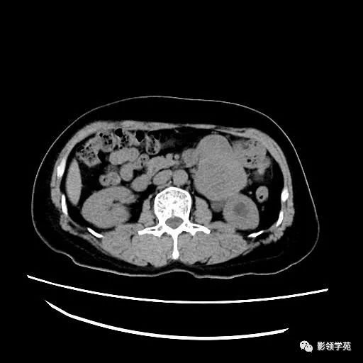 影像PPT - 【病例】腹膜后平滑肌肉瘤1例CT表现-3 影像PPT - 【病例】腹膜后平滑肌肉瘤1例CT表现-3