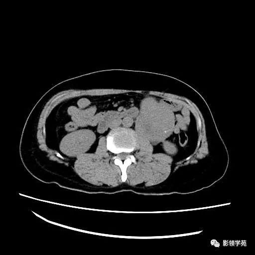 影像PPT - 【病例】腹膜后平滑肌肉瘤1例CT表现-4 影像PPT - 【病例】腹膜后平滑肌肉瘤1例CT表现-4