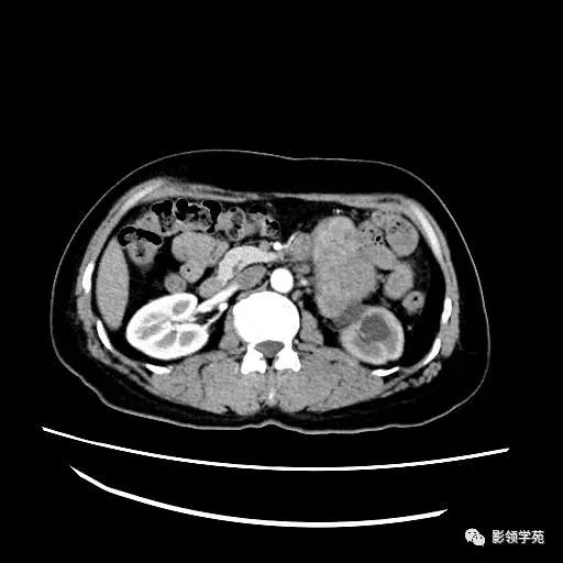 影像PPT - 【病例】腹膜后平滑肌肉瘤1例CT表现-5 影像PPT - 【病例】腹膜后平滑肌肉瘤1例CT表现-5