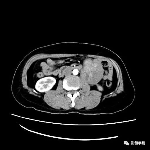 影像PPT - 【病例】腹膜后平滑肌肉瘤1例CT表现-7 影像PPT - 【病例】腹膜后平滑肌肉瘤1例CT表现-7