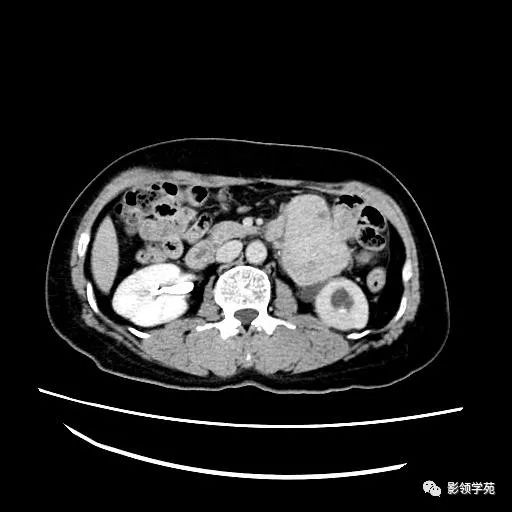 影像PPT - 【病例】腹膜后平滑肌肉瘤1例CT表现-10 影像PPT - 【病例】腹膜后平滑肌肉瘤1例CT表现-10