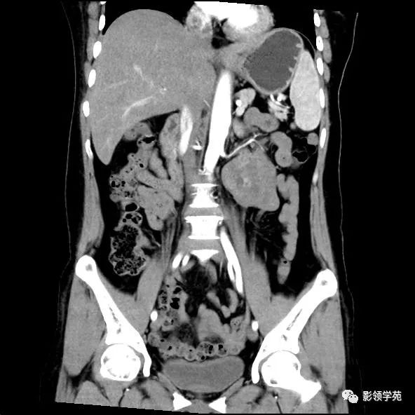 影像PPT - 【病例】腹膜后平滑肌肉瘤1例CT表现-12 影像PPT - 【病例】腹膜后平滑肌肉瘤1例CT表现-12
