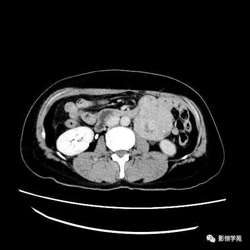 影像PPT - 【病例】腹膜后平滑肌肉瘤1例CT表现-11 影像PPT - 【病例】腹膜后平滑肌肉瘤1例CT表现-11
