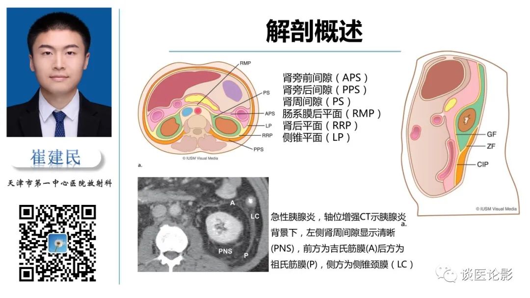 影像PPT - 【PPT】肾周间隙肿瘤性病变影像表现-3 影像PPT - 【PPT】肾周间隙肿瘤性病变影像表现-3