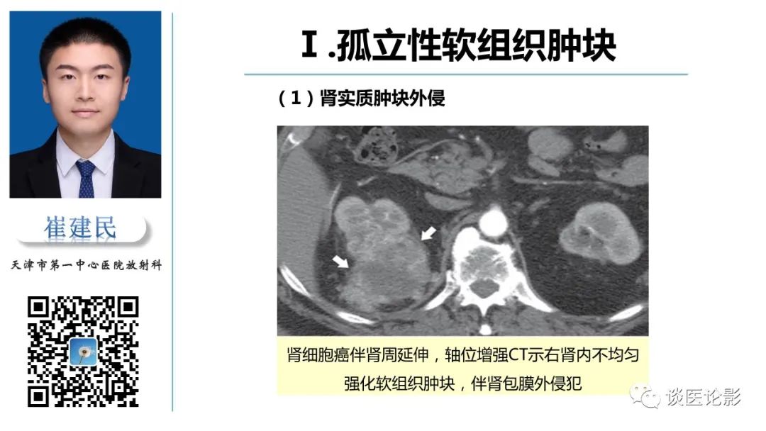 影像PPT - 【PPT】肾周间隙肿瘤性病变影像表现-9 影像PPT - 【PPT】肾周间隙肿瘤性病变影像表现-9