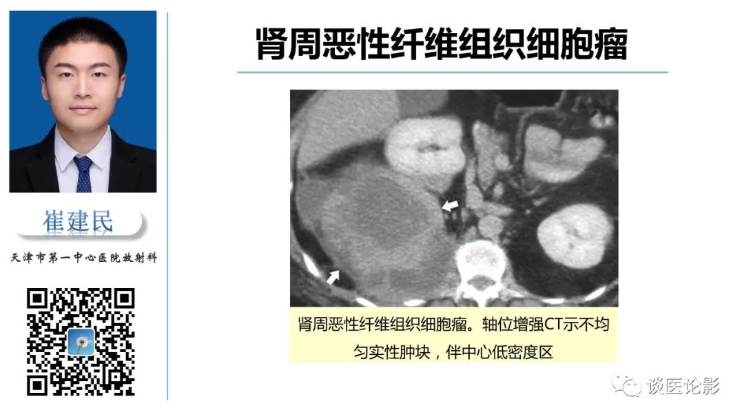 影像PPT - 【PPT】肾周间隙肿瘤性病变影像表现-11 影像PPT - 【PPT】肾周间隙肿瘤性病变影像表现-11