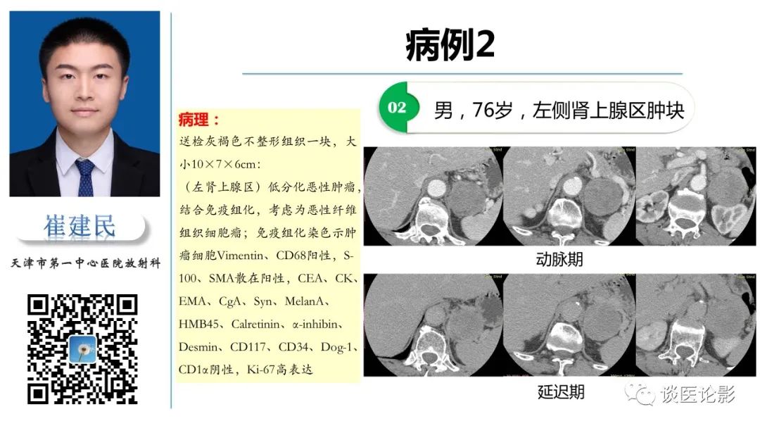 影像PPT - 【PPT】肾周间隙肿瘤性病变影像表现-13 影像PPT - 【PPT】肾周间隙肿瘤性病变影像表现-13