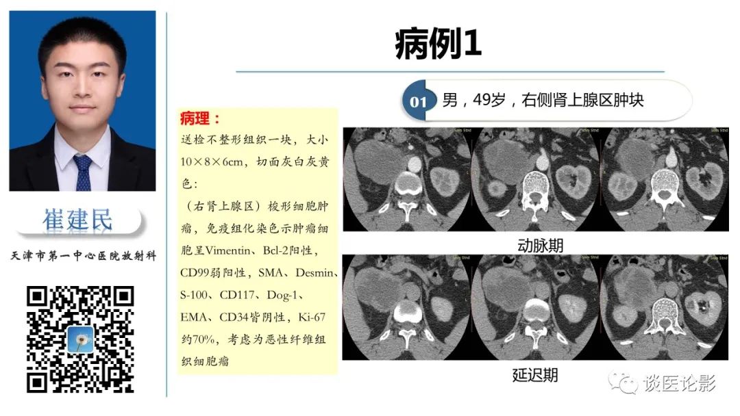 影像PPT - 【PPT】肾周间隙肿瘤性病变影像表现-12 影像PPT - 【PPT】肾周间隙肿瘤性病变影像表现-12