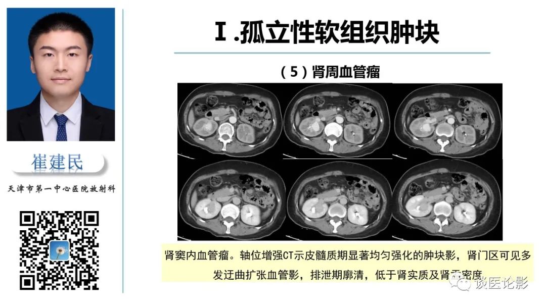 影像PPT - 【PPT】肾周间隙肿瘤性病变影像表现-17 影像PPT - 【PPT】肾周间隙肿瘤性病变影像表现-17