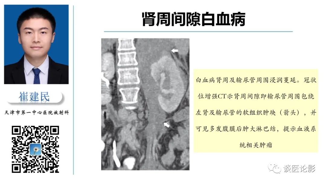 影像PPT - 【PPT】肾周间隙肿瘤性病变影像表现-24 影像PPT - 【PPT】肾周间隙肿瘤性病变影像表现-24