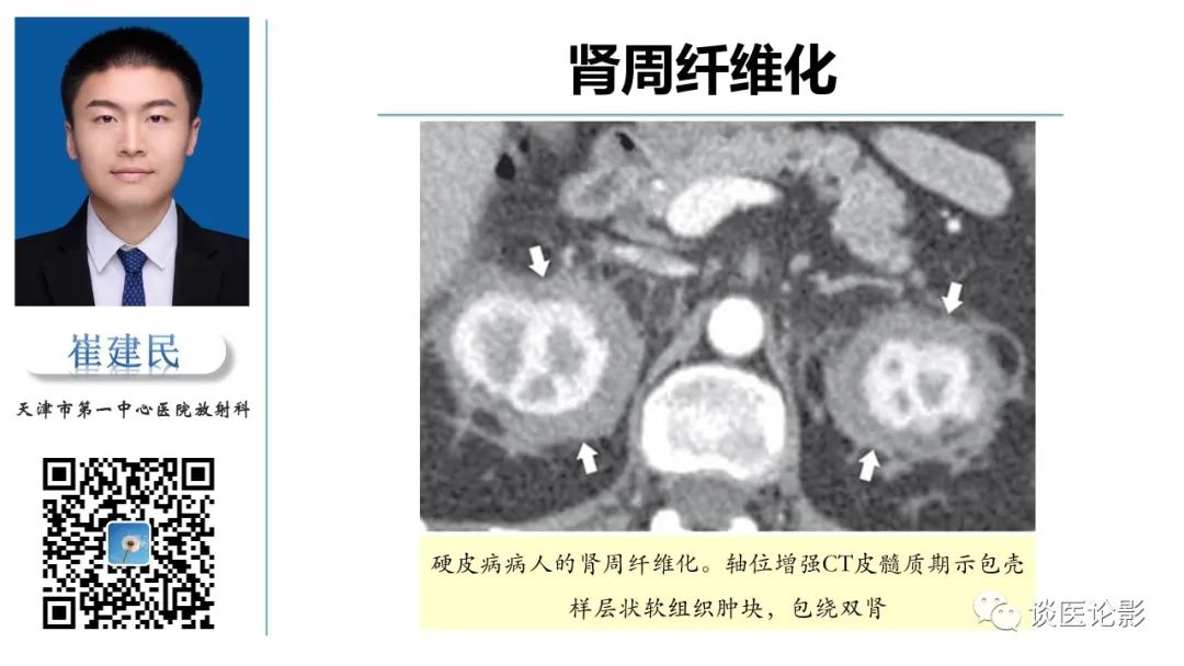 影像PPT - 【PPT】肾周间隙肿瘤性病变影像表现-26 影像PPT - 【PPT】肾周间隙肿瘤性病变影像表现-26