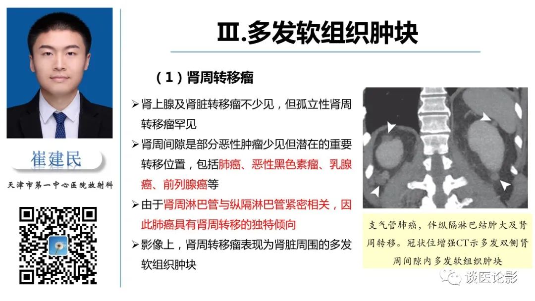 影像PPT - 【PPT】肾周间隙肿瘤性病变影像表现-30 影像PPT - 【PPT】肾周间隙肿瘤性病变影像表现-30