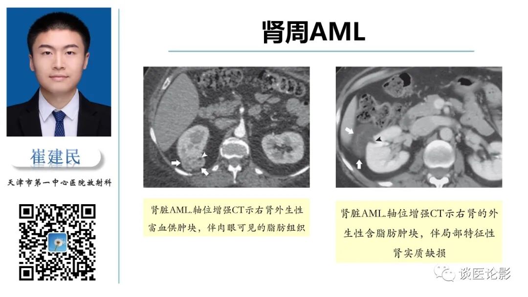 影像PPT - 【PPT】肾周间隙肿瘤性病变影像表现-34 影像PPT - 【PPT】肾周间隙肿瘤性病变影像表现-34