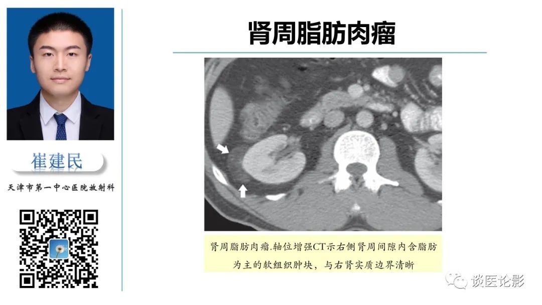 影像PPT - 【PPT】肾周间隙肿瘤性病变影像表现-36 影像PPT - 【PPT】肾周间隙肿瘤性病变影像表现-36