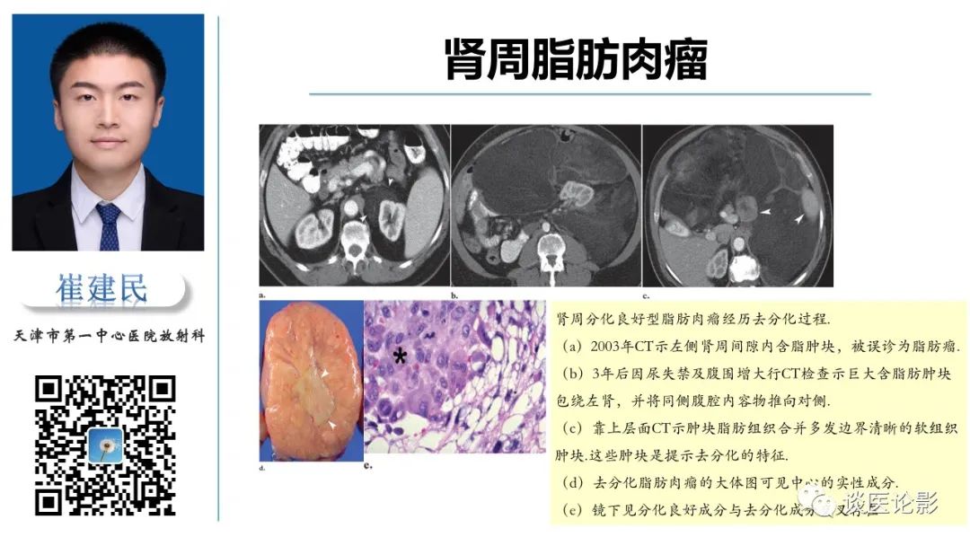 影像PPT - 【PPT】肾周间隙肿瘤性病变影像表现-37 影像PPT - 【PPT】肾周间隙肿瘤性病变影像表现-37