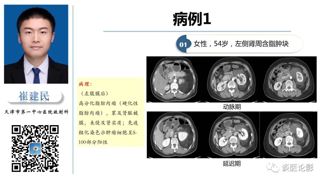 影像PPT - 【PPT】肾周间隙肿瘤性病变影像表现-38 影像PPT - 【PPT】肾周间隙肿瘤性病变影像表现-38