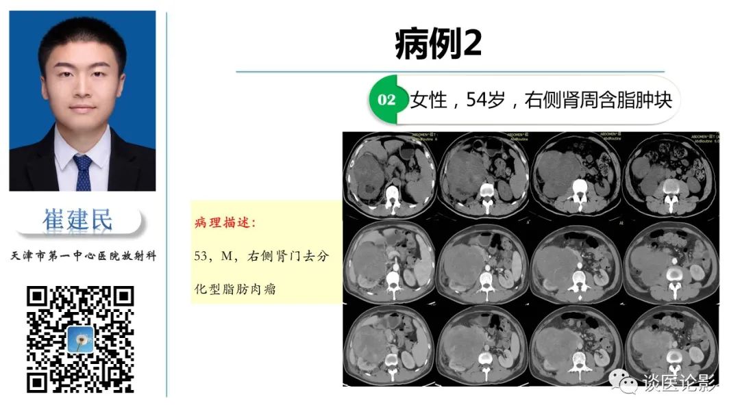影像PPT - 【PPT】肾周间隙肿瘤性病变影像表现-40 影像PPT - 【PPT】肾周间隙肿瘤性病变影像表现-40