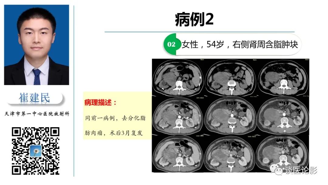 影像PPT - 【PPT】肾周间隙肿瘤性病变影像表现-41 影像PPT - 【PPT】肾周间隙肿瘤性病变影像表现-41