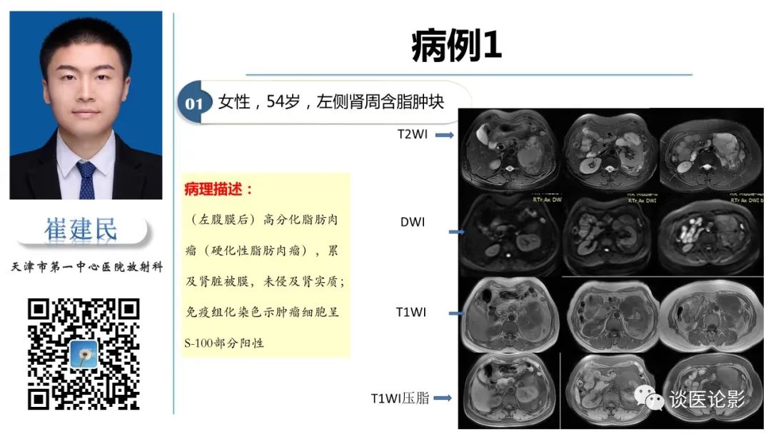 影像PPT - 【PPT】肾周间隙肿瘤性病变影像表现-39 影像PPT - 【PPT】肾周间隙肿瘤性病变影像表现-39