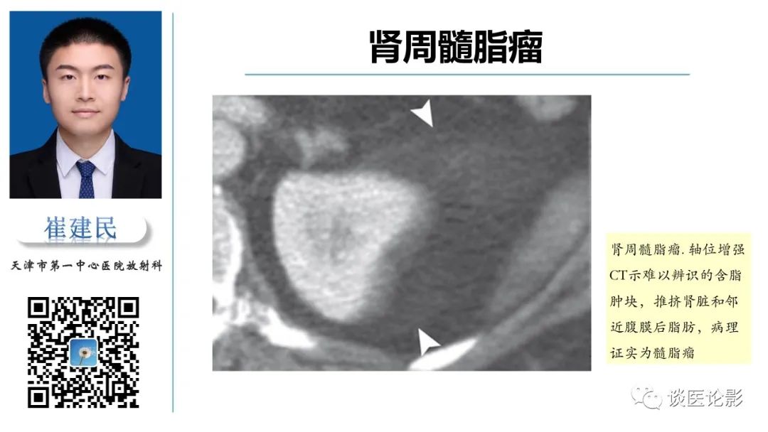影像PPT - 【PPT】肾周间隙肿瘤性病变影像表现-45 影像PPT - 【PPT】肾周间隙肿瘤性病变影像表现-45