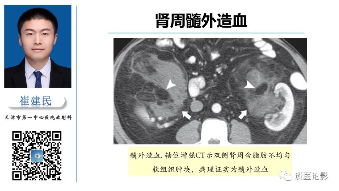 影像PPT - 【PPT】肾周间隙肿瘤性病变影像表现-43 影像PPT - 【PPT】肾周间隙肿瘤性病变影像表现-43