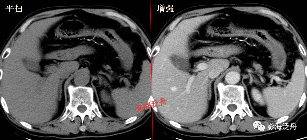 影像PPT - 【病例】肠梗阻里面的连环套-2 影像PPT - 【病例】肠梗阻里面的连环套-2