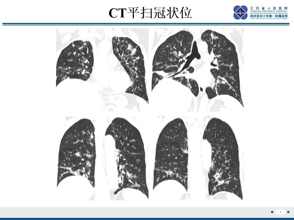 影像PPT - 【PPT】免疫检查点抑制剂相关性肺炎影像表现-5