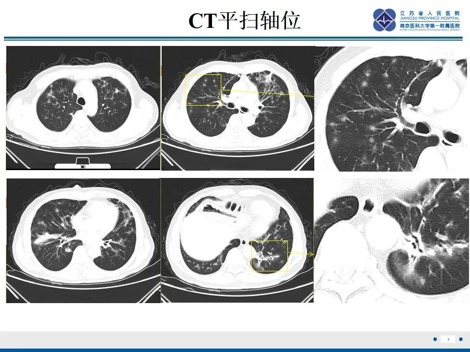 影像PPT - 【PPT】免疫检查点抑制剂相关性肺炎影像表现-4